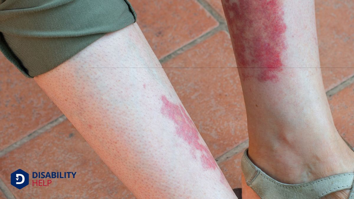 Systemic Vasculitis